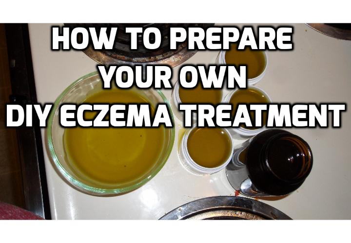 DIY Eczema Treatment for Soothing Itchy and Irritated Skin - Read on to find out how you can prepare your own DIY eczema treatment to soothe itchy and irritated skin.
