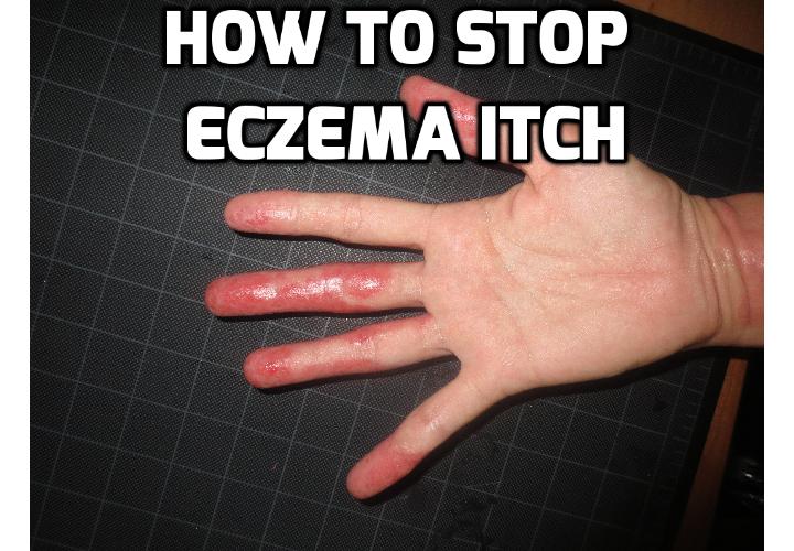 How to Relieve Eczema Itch? Eczema is one condition that is painful, uncomfortable and yes, even debilitating. For many people the search for an effective, safe and inexpensive way to relieve eczema itch is a constant struggle. Here are some home remedies for you to stop eczema itching.