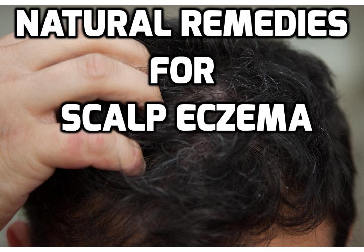 Scalp Eczema Treatment – Safe Remedies for Pesky Flakes and Itchiness - Scalp eczema is embarrassing, extremely uncomfortable and frustrating. If left untreated, eczema on the scalp can lead to stunted hair growth and hair loss. For this very reason, the timely administration of scalp eczema treatment is highly recommended to keep the condition in tight check. Read on to find out more.