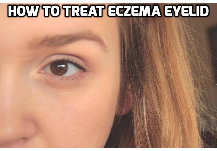 How to Prevent and Treat Eczema on Eyelid? People who are looking for ways to treat eczema on eyelid usually suffer from swollen, wrinkled, itching or burning eyelids. And given the fact that it is near the eye area, extra care should be taken to avoid complications. Read on to find out more.
