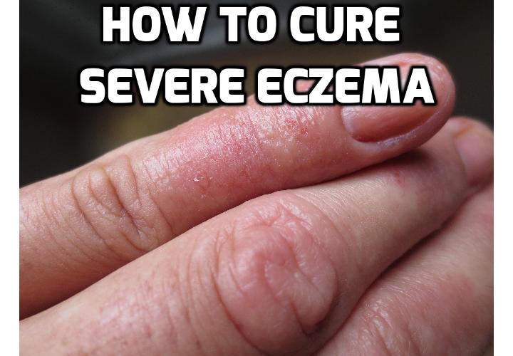 How to Treat Severe Eczema? If you have severe eczema, don’t lose hope. With a solid eczema treatment program, which involves a multifaceted approach that includes medical treatments and lifestyle modifications, you can find relief and restore your skin’s texture and health. Read on to find out more.