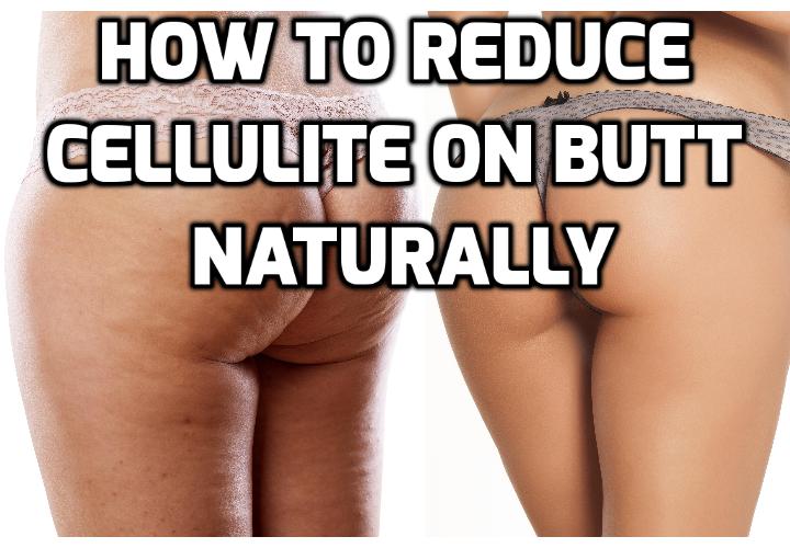 How to Lose Cellulite on Butt Naturally Fast? Do you want to lose cellulite on butt forever? You will know how great it feels when you slip on your skinny jeans, or that little black dress that’s waiting for you in your closet. Read on to find out more.