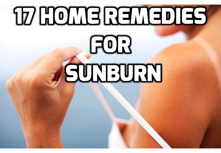 17 Naturally Soothing Sunburn Treatments - The best thing to do is prevent sunburn, but even when you do try to protect yourself, you may end up burned anyways. To avoid peeling and get rid of the redness and stinging, here are 17 sunburn treatments that are simple, fast, and effective.