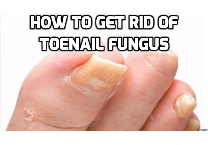 3 Simple Home Remedies for Toenail Fungus - If you are looking for ways to treat toenail discoloration, here are 3 simple home remedies for toenail fungus, but at the same time don’t overlook preventative methods to keep the fungus from coming back.