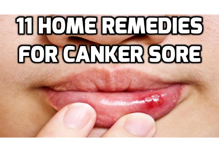 11 Home Remedies to Get Rid of Canker Sores - Apthous stomatitis, more commonly known as canker sores, are mysterious mouth ulcers that have plagued most people at some point in their lives. Here are 11 home remedies you can use to get rid of canker sores.