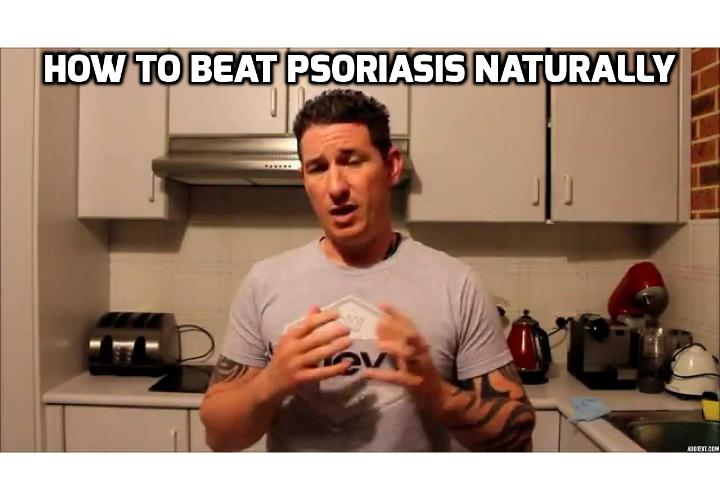 What really Causes Psoriasis & How best to Fight Psoriasis? Learning how to fight psoriasis is best started by figuring out what causes psoriasis outbreak in the first place and dealing with it from there. Read on to find out more.