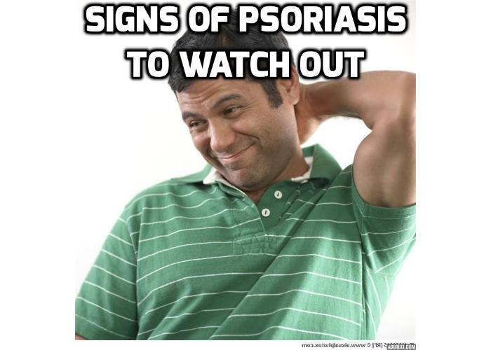 Revealing Here the 6 Warning Signs of Psoriasis - Read on here to learn all about psoriasis. Get information about the causes and warning signs of psoriasis and treatments for psoriasis.