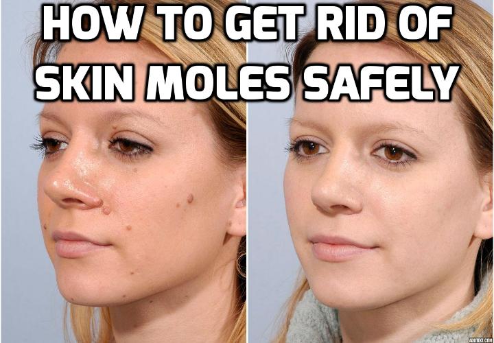 How Best to Really Remove Skin Moles Absolutely? Skin moles are skin growths that may have a variety of colors, shapes and sizes. Although some may be regarded as beauty marks, many others are quite unsightly which is why many people are looking for ways to remove skin moles.