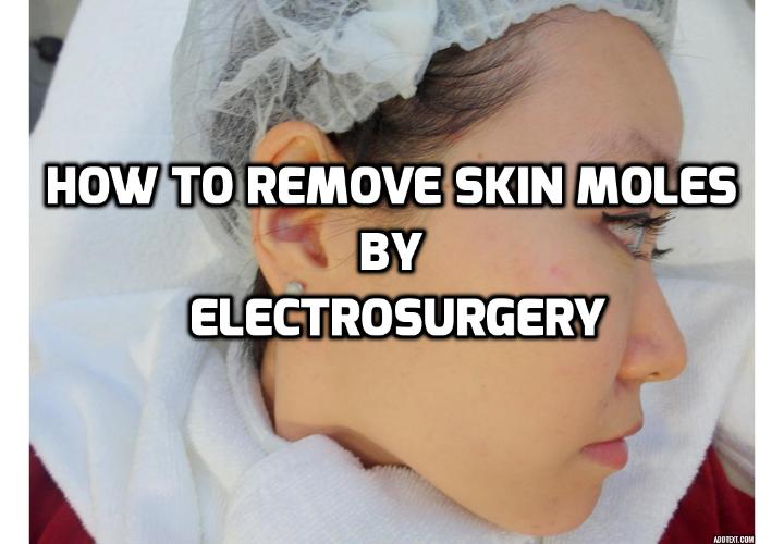 How to Remove Skin Moles by Electrosurgery – Is It Really Best? Electrosurgery or electrocautery is a surgical procedure that can be used to remove skin moles. The process involves the application of an instrument heated by an electric current on the area in consideration. Read on here to find out more about this skin moles treatment procedure.