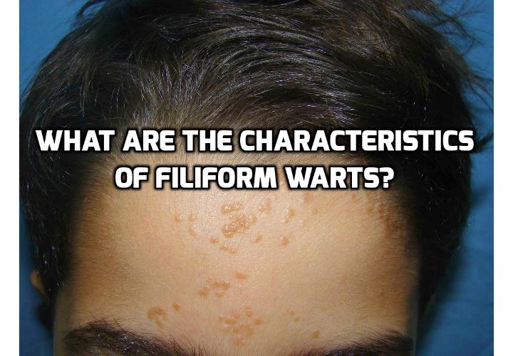 Revealing Here 10 Important Facts about Filiform Warts - Filiform warts generally occur on visible areas of the individual, they may create some discomforts relating to the aesthetic aspect. In view of this one may consider treatment. Read on here to find out more.