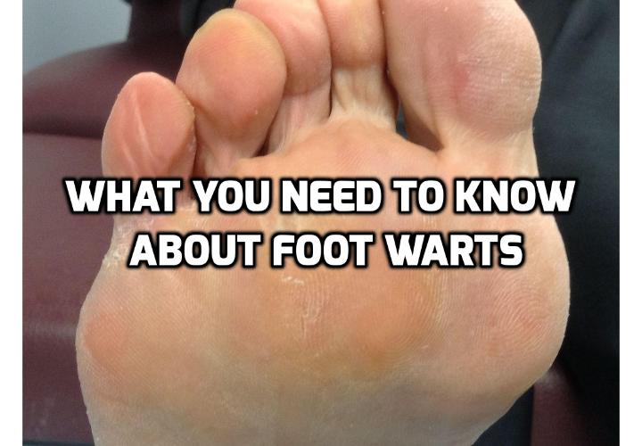 How Best to Really Cure and Prevent Foot Warts? There are many types of foot warts treatments that can help you to treat this type of wart. They include over the counter wart removal treatments, surgical wart removal treatment and home treatments for warts. Read on here to find out more.