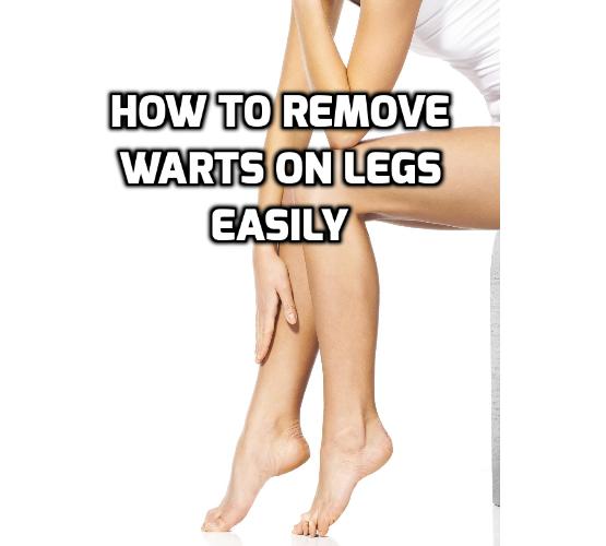 How Best to Really Remove Leg Warts Absolutely?  Leg warts are more common on the legs of women than that of men. They are also more common in children and adolescents than older individuals. Read on here to find out how to remove leg warts.