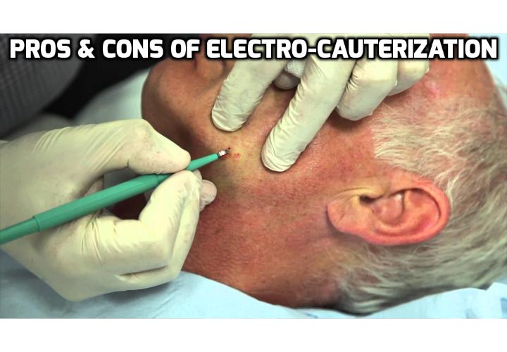 Is Skin Tag Removal by Electro-Cauterization Really The Best? You can try skin tag removal by electro-cauterization. But before you make the decision to choose this procedure to remove your skin tag, read on here to learn the advantages and disadvantages of this skin tag treatment.